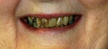 colorado springs dental crowns