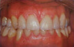 dental crowns colorado springs