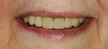 dental bridges colorado springs
