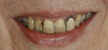 dental veneers colorado springs