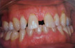 dental crowns colorado springs