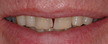 colorado springs porcelain crowns