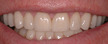 porcelain crowns colorado springs