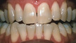 teeth whitening colorado springs