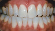 colorado springs teeth whitening
